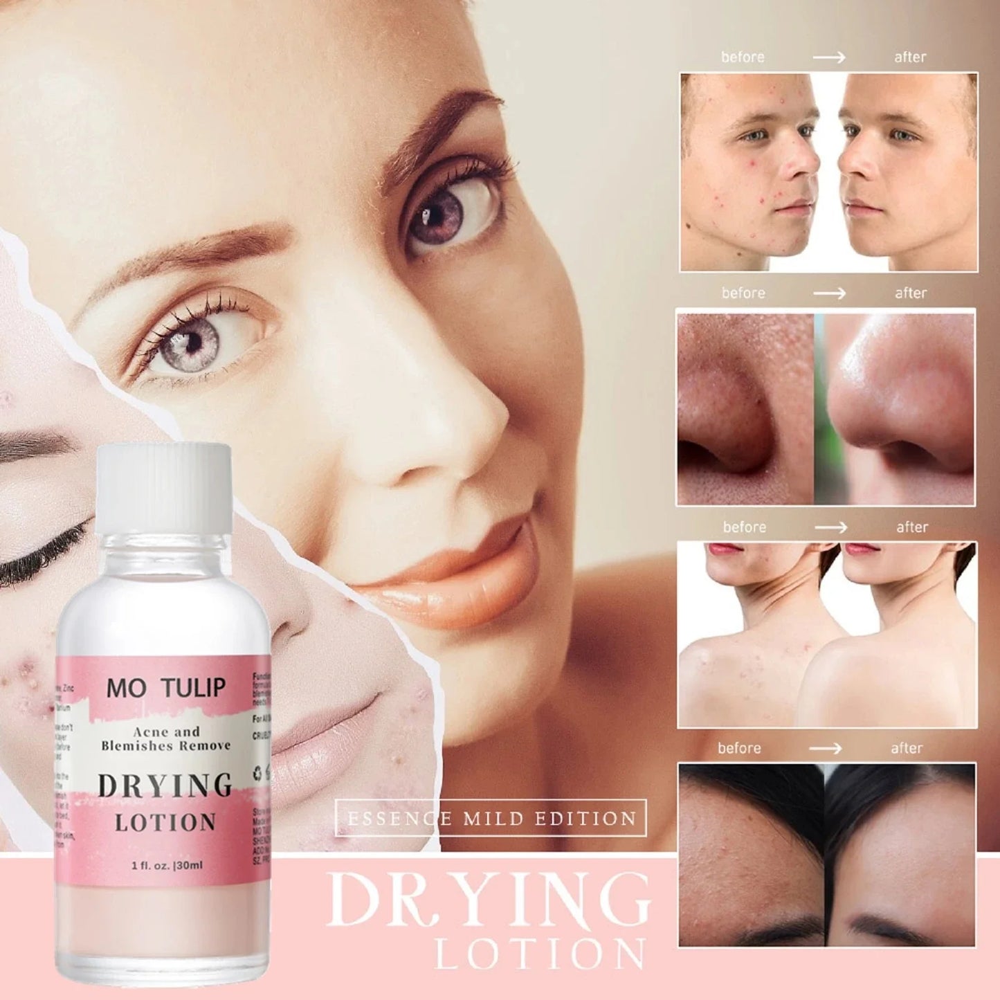 Fast Acting Acne Treatment - Pore Drying Lotion